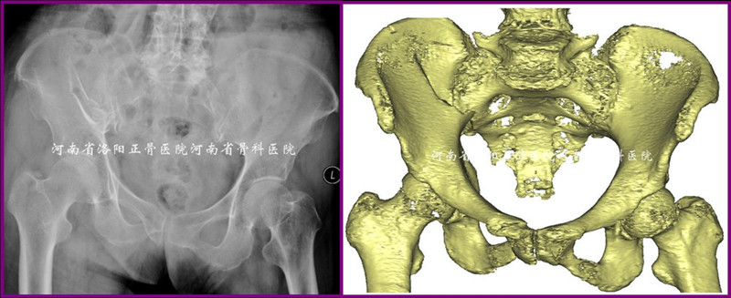 图1 一例88岁女性骨盆骨折的影像资料.