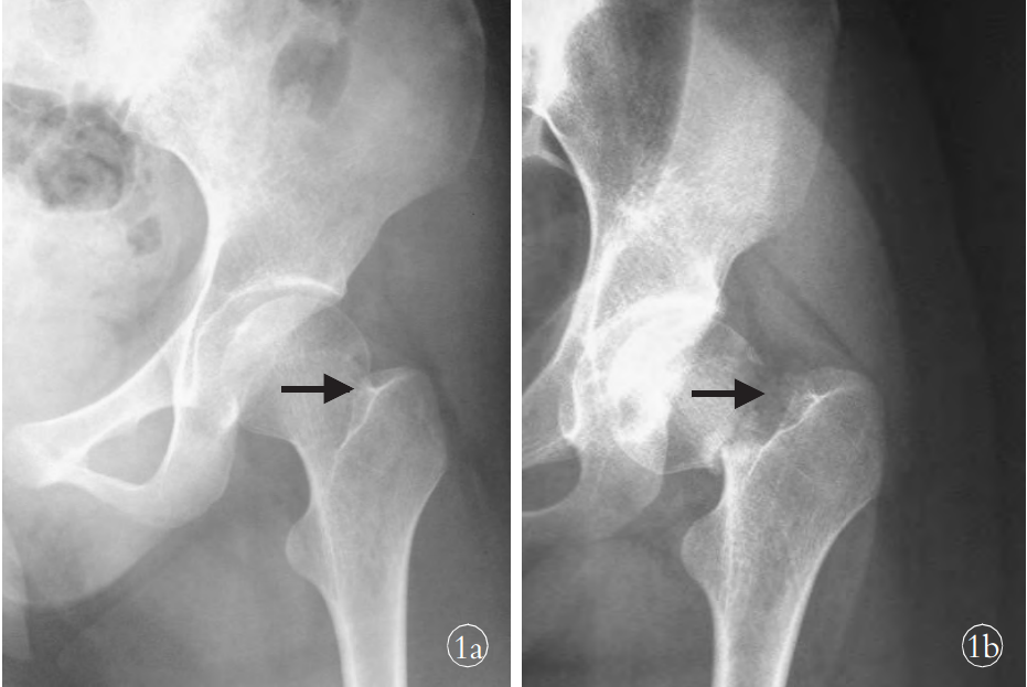 左股骨颈基底部骨折早期漏诊1例