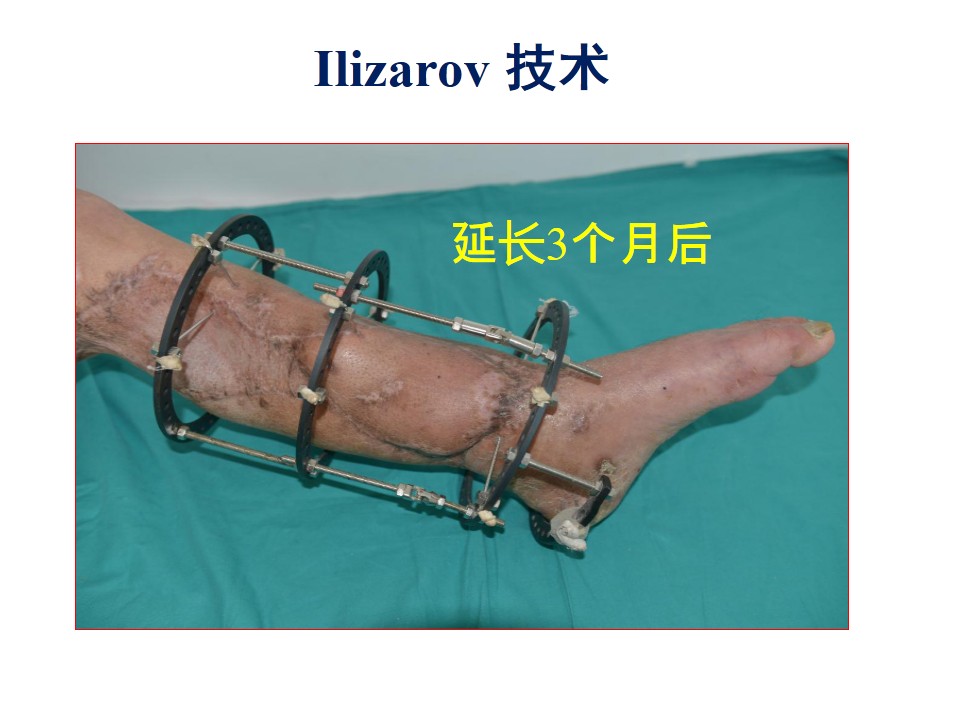 显微外科联合ilizarov技术修复下肢复合伤