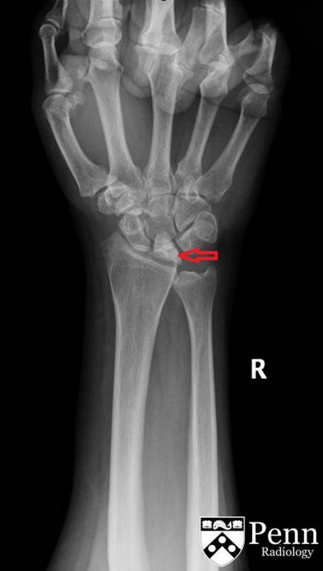 kienbck"s 病),是一种以月骨碎裂,进行性塌陷为主要表现的腕关节疾患