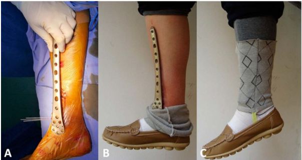 治疗胫骨远端骨折预塑型股骨远端锁定钢板显神通