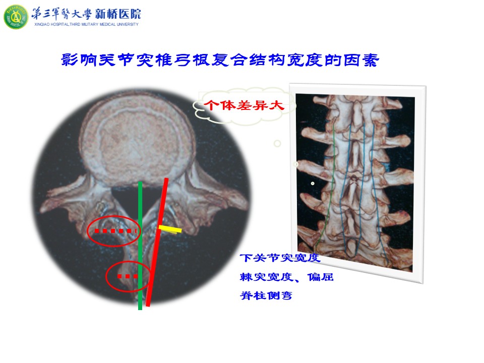 腰椎经皮关节突椎弓根螺钉植入的应用解剖研究