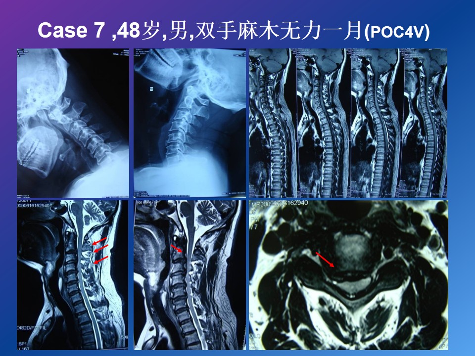 颈椎病的压迫方式与手术入路理性化选择