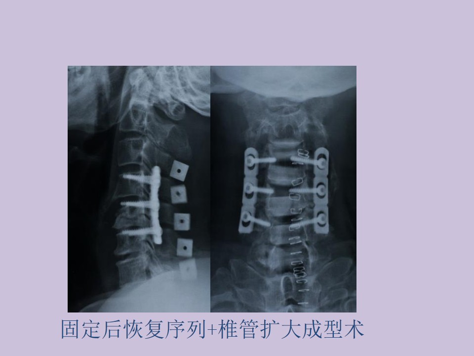 后路颈椎椎弓根螺丝钉固定技术