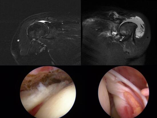 肩袖损伤治疗篇细节决定手术成败骨医小灶第二十五期下