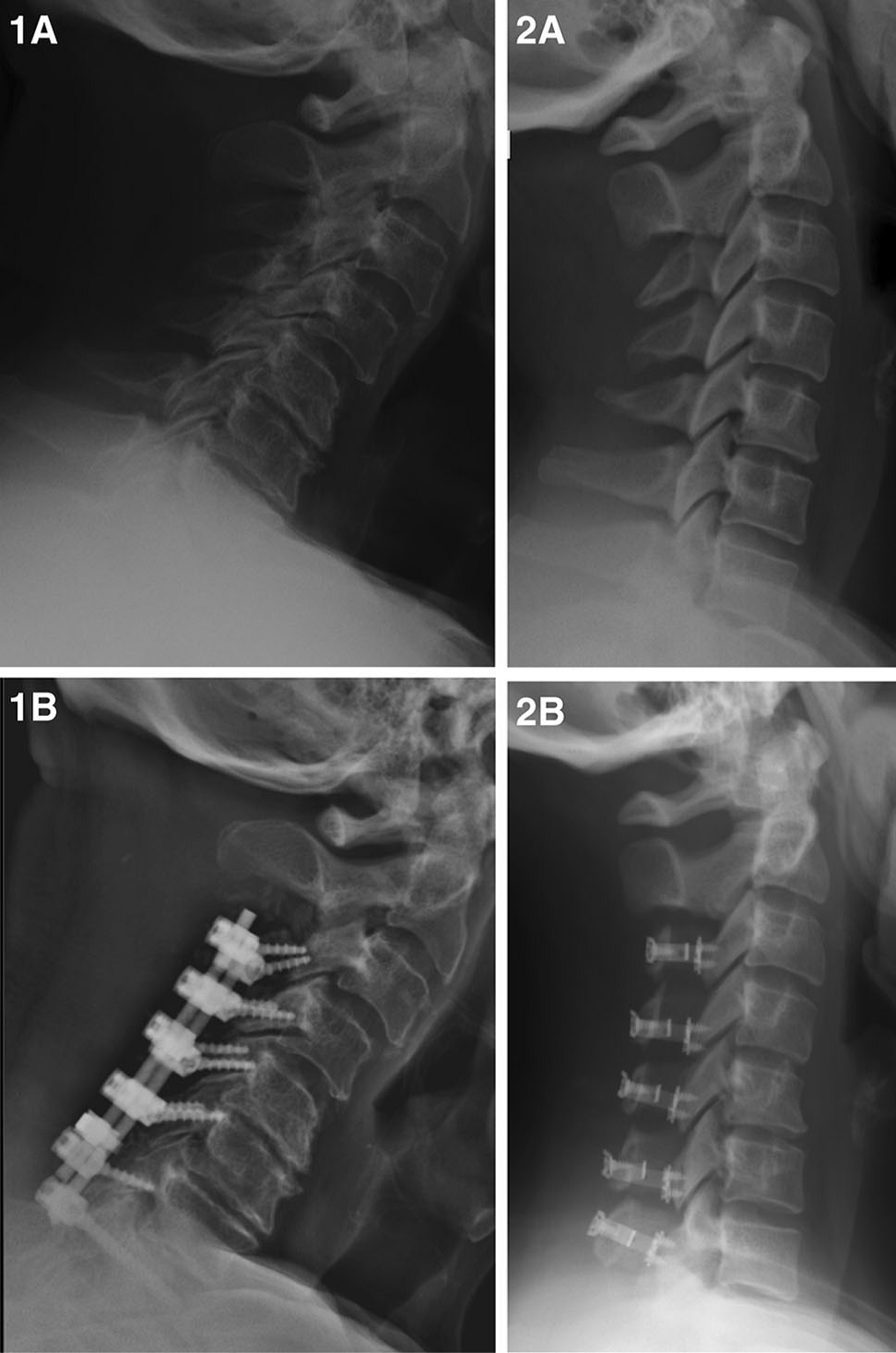 骨科前沿丨颈椎单开门椎板成形术和椎板切除减压融合内固定术治疗脊髓