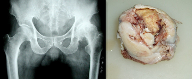 早期股骨头坏死的诊断与分期——骨医小灶第二十二期