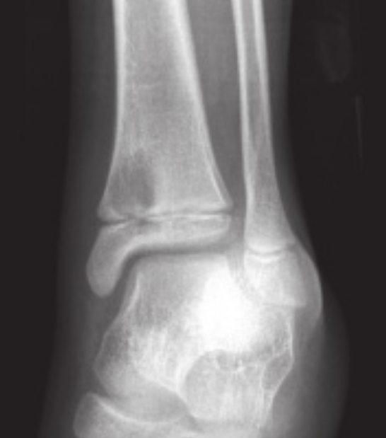 亚急性骨髓炎患儿踝关节前后位x线片显示低密度区跨过骺板扩展到骨骺