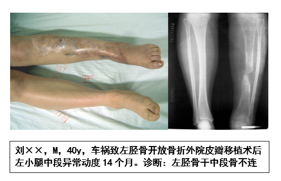 胫骨干中段骨不连