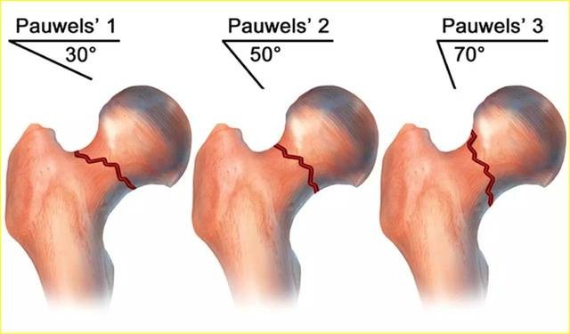 专栏/您知道股骨颈骨折pauwels分型的缺陷吗?