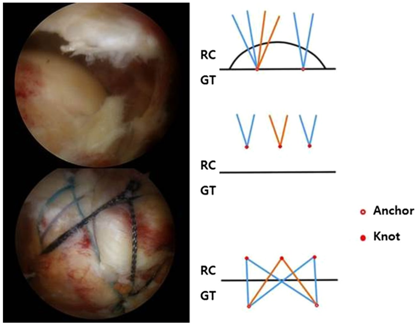 缝线桥技术示意图 rc:肩袖,gt: 大结节