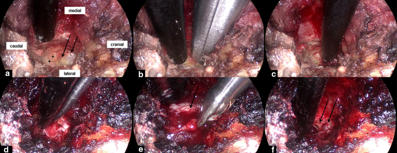 骨科前沿丨全内镜处理腰椎术中硬脊膜撕裂