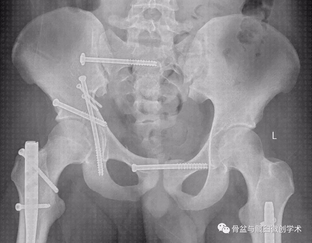 骨科外固定：骨盆支架在骨盆骨折手术中的运用_损伤_挤压_螺钉