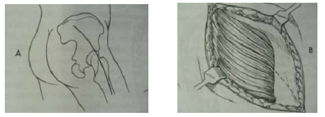 髋关节直接前入路daa手术