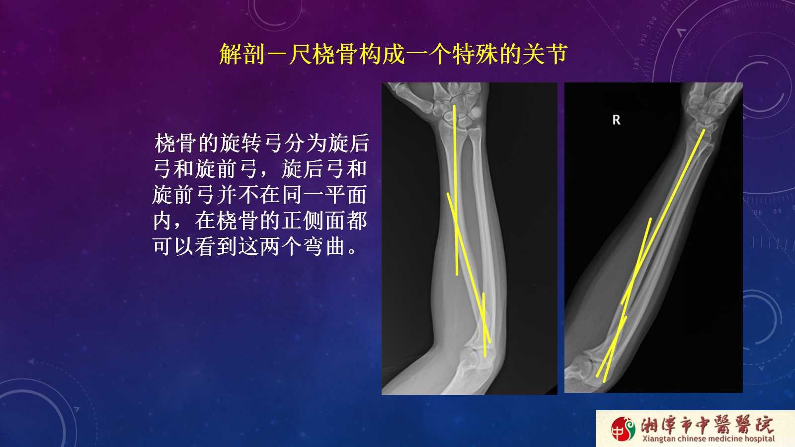 杨氏旋后牵引法治疗尺桡骨中段双骨折