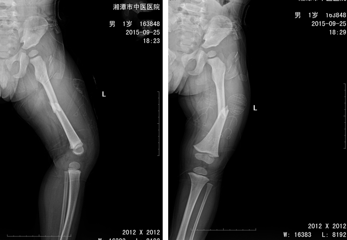 入院时拍片情况可见股骨中段骨折,断端成角移位