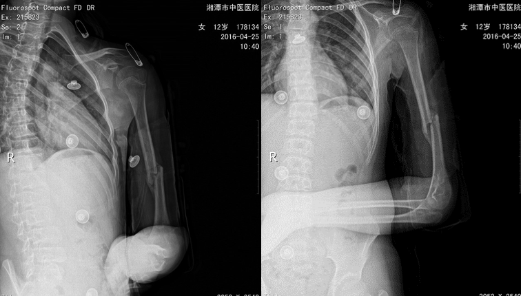 治疗近一个半月拍片复查可见骨痂生长明显