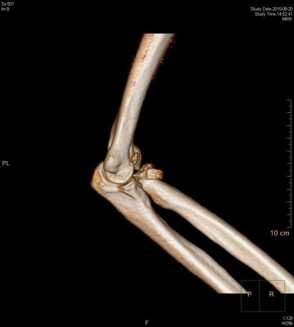 x线检查和ct检查,提示:肘关节脱位合并桡骨头骨折以及尺骨冠突骨折