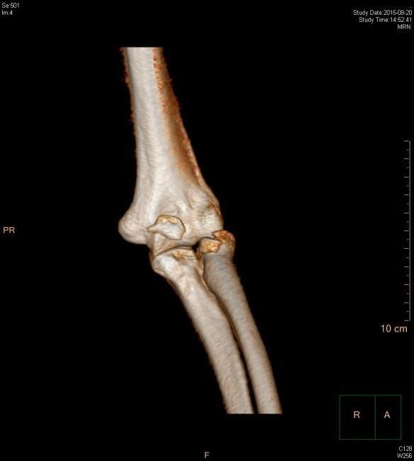 x线检查和ct检查,提示:肘关节脱位合并桡骨头骨折以及尺骨冠突骨折