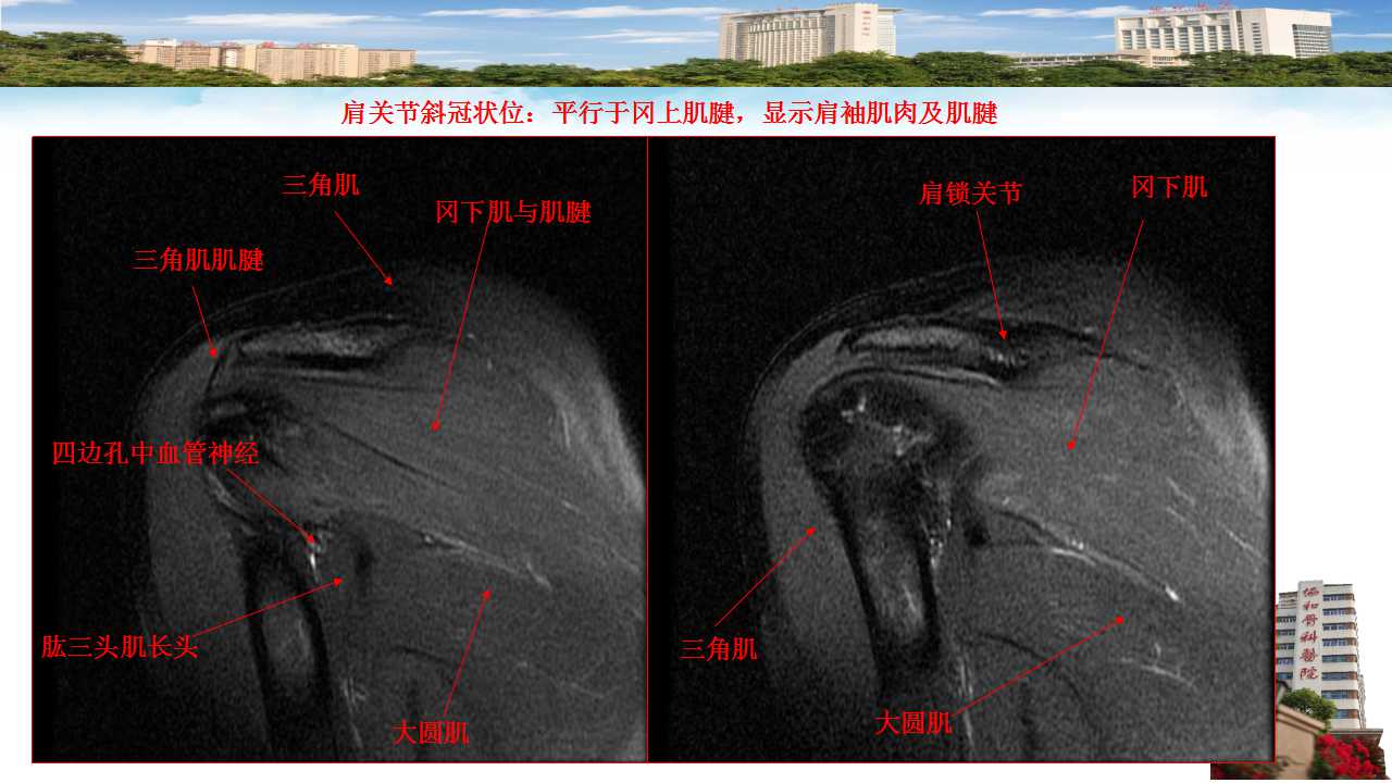 肩袖损伤的mri诊断及指南解读