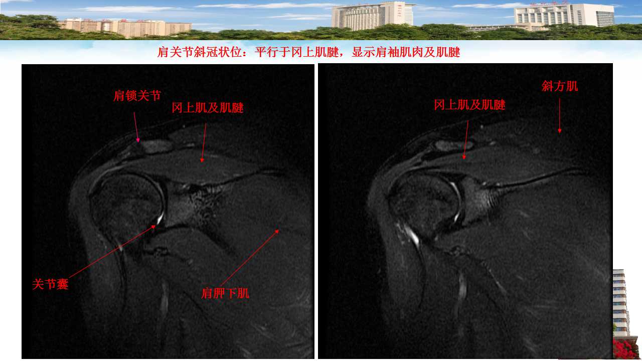 肩袖损伤的mri诊断及指南解读