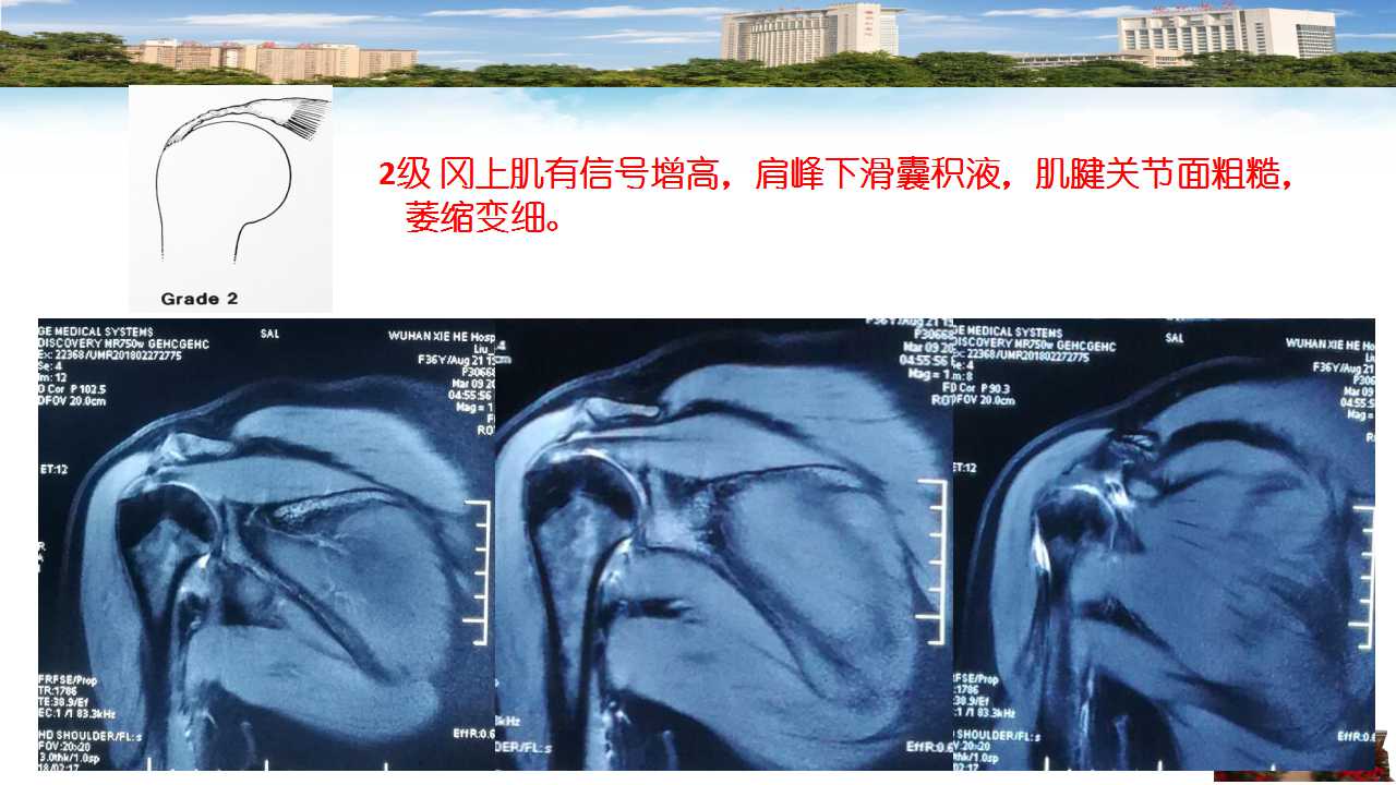 肩袖损伤的mri诊断及指南解读