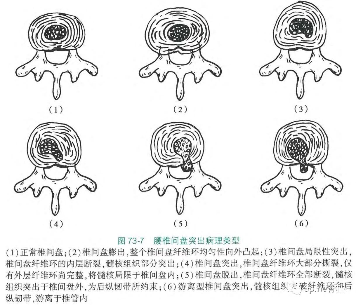 分型之谜腰椎间盘突出症