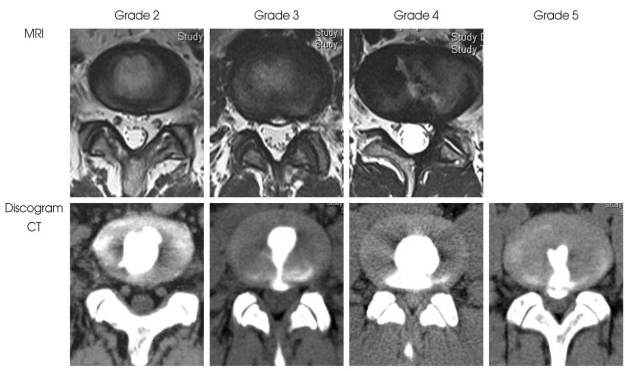 纤维环破裂分级mri及造影后ct示意图终板破裂分级示意