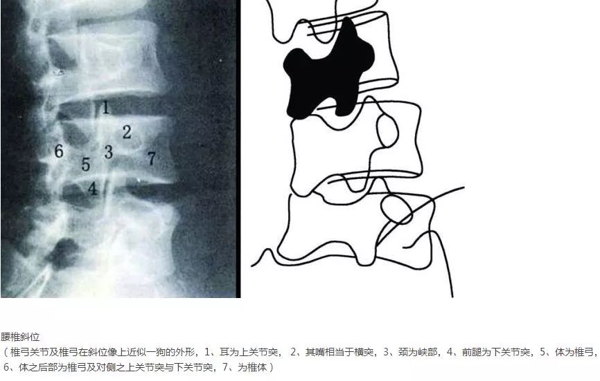 带你认识腰椎峡部裂