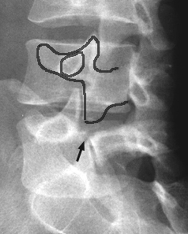 腰椎斜位片,图中黑色箭头所示为峡部裂