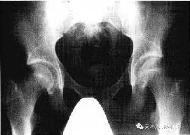 (perthes病)儿童股骨头坏死---分型 ( herring 外侧柱