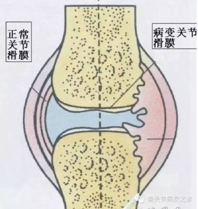 膝关节滑膜炎的诊断和治疗