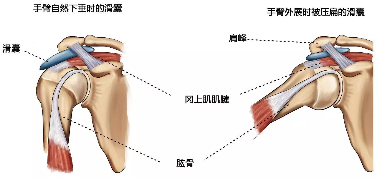 60%的肩痛是肩峰下撞击综合征