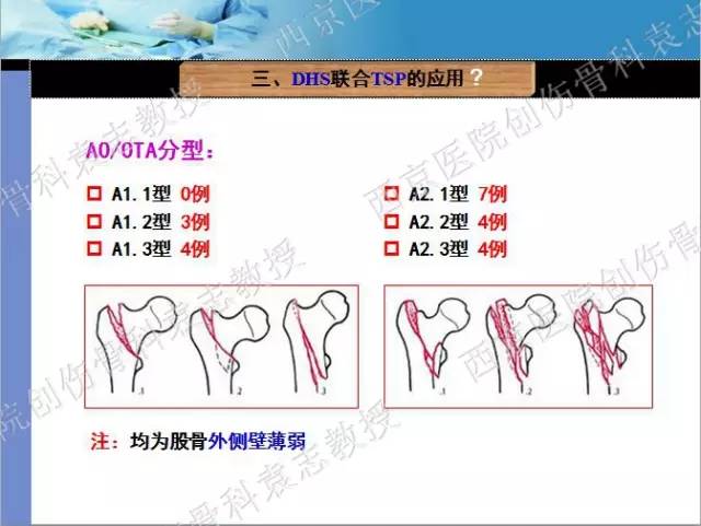 学术分享动力髋钉板dhs联合保护钢板tsp治疗股骨转子间骨折