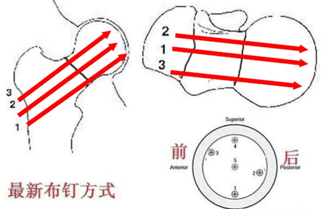 iii型,pauwels角>50°,剪切力较大,骨折不稳定