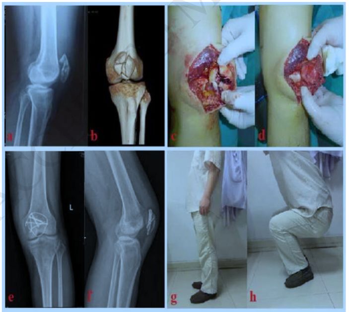 c3型髌骨骨折手术治疗时翻转与不翻转髌骨临床疗效对比研究