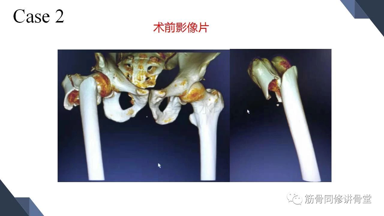 合并大转子冠状位骨折的股骨近端骨折的治疗