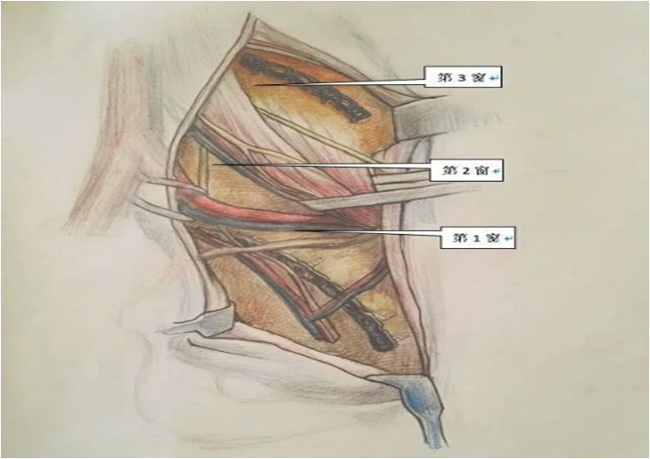 专题教程骨盆髋臼骨折前方手术入路stoppa及其改良入路