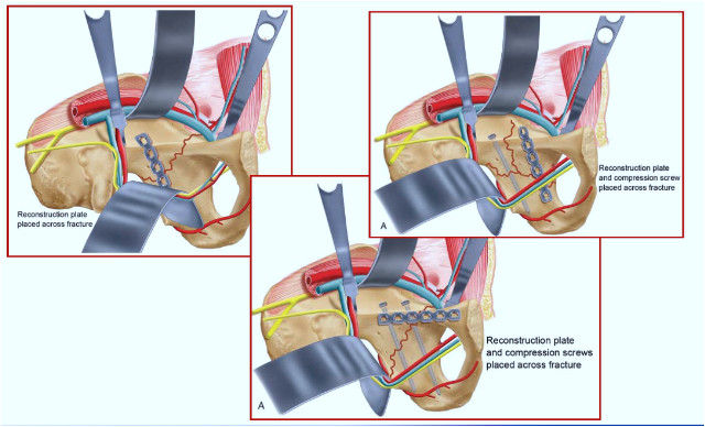 专题教程:骨盆髋臼骨折前方手术入路--stoppa及其改良