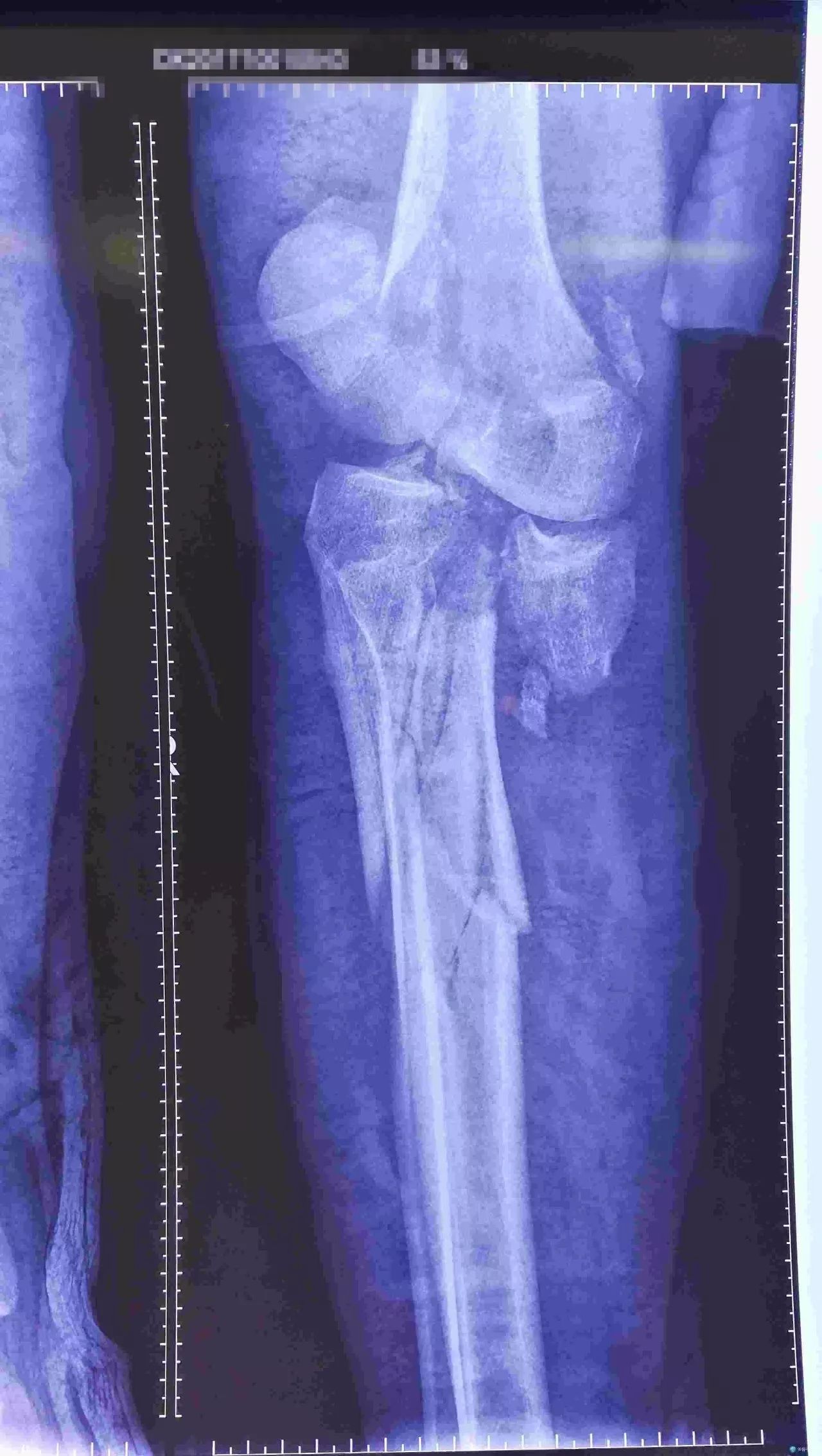 讲骨堂:膝关节脱位型胫骨平台如何处理更好?