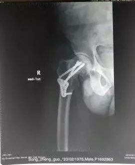讲骨堂股骨颈骨折断钉骨不连的翻修