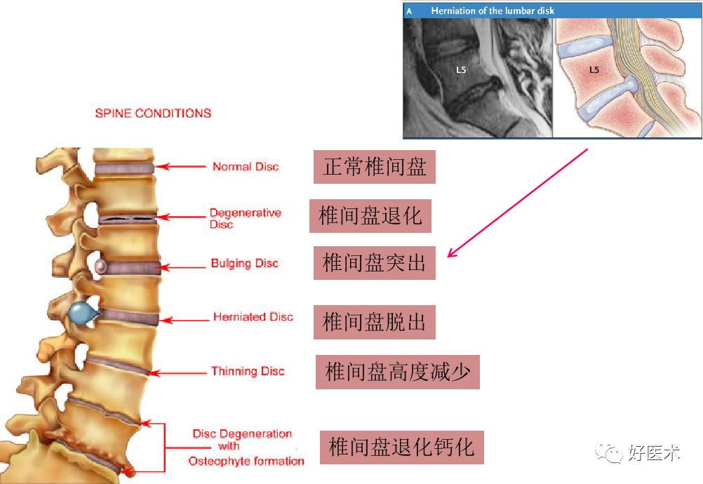 详解:腰椎间盘突出症