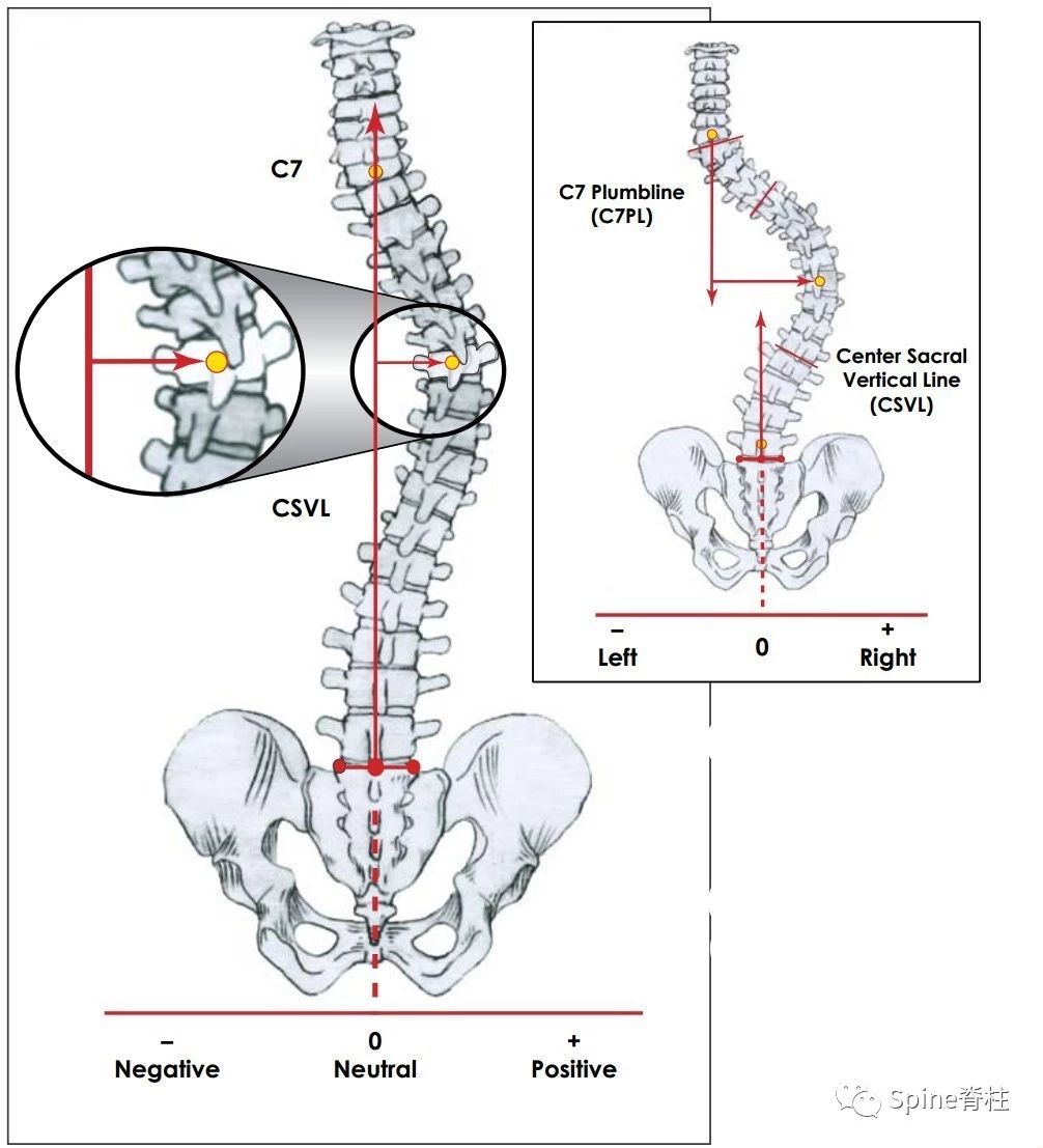 骶骨中垂线(center sacral vertical line, cs