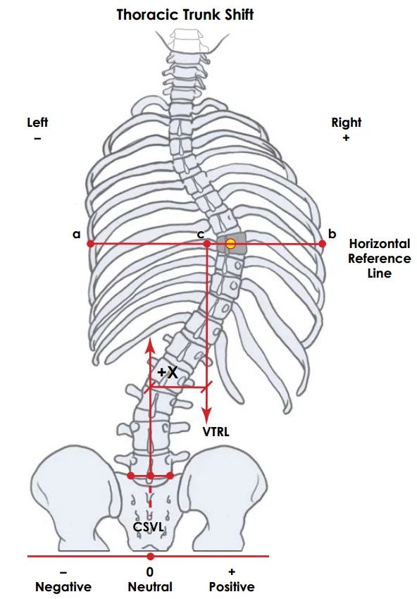 sagittal alignment)是采用cobb法测量头侧t12椎体上终板到尾侧s1椎体