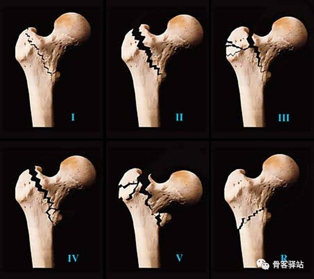 5)r:为反转子间骨折,骨折线由内上斜向外下,可伴有小转子骨折,股骨距