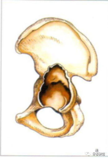 髋关节疾病常见分型汇总