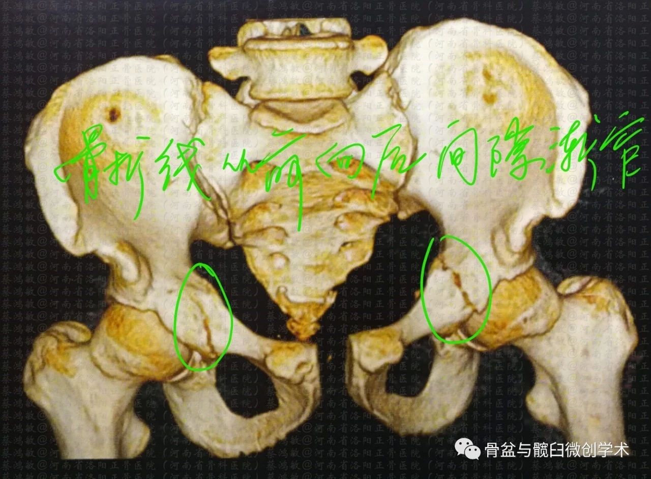 五,左侧髋臼骨折:髂耻线及髂坐线均中断,而闭孔环骨质完整.