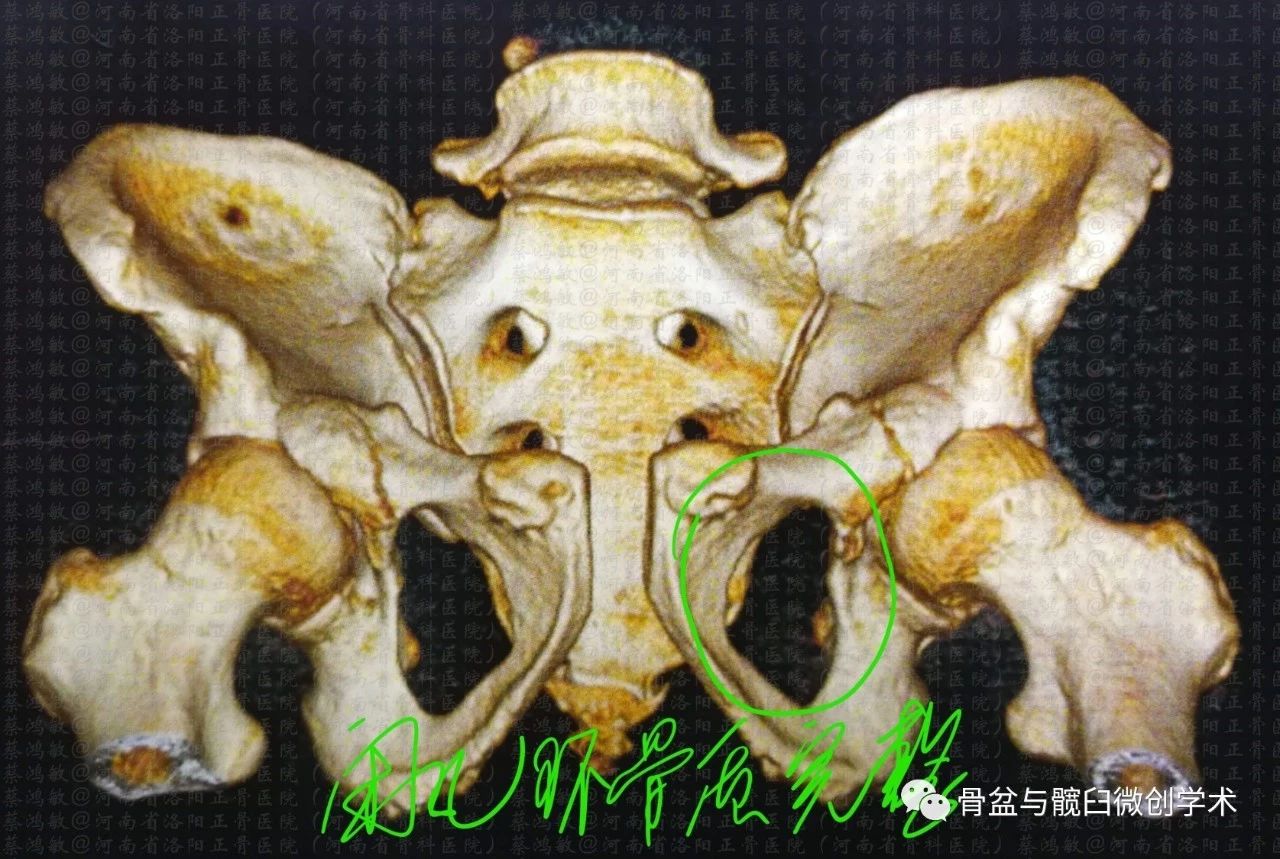 骨盆骨折youngburgessapci合并髋臼骨折judetletournel横形的微创手术