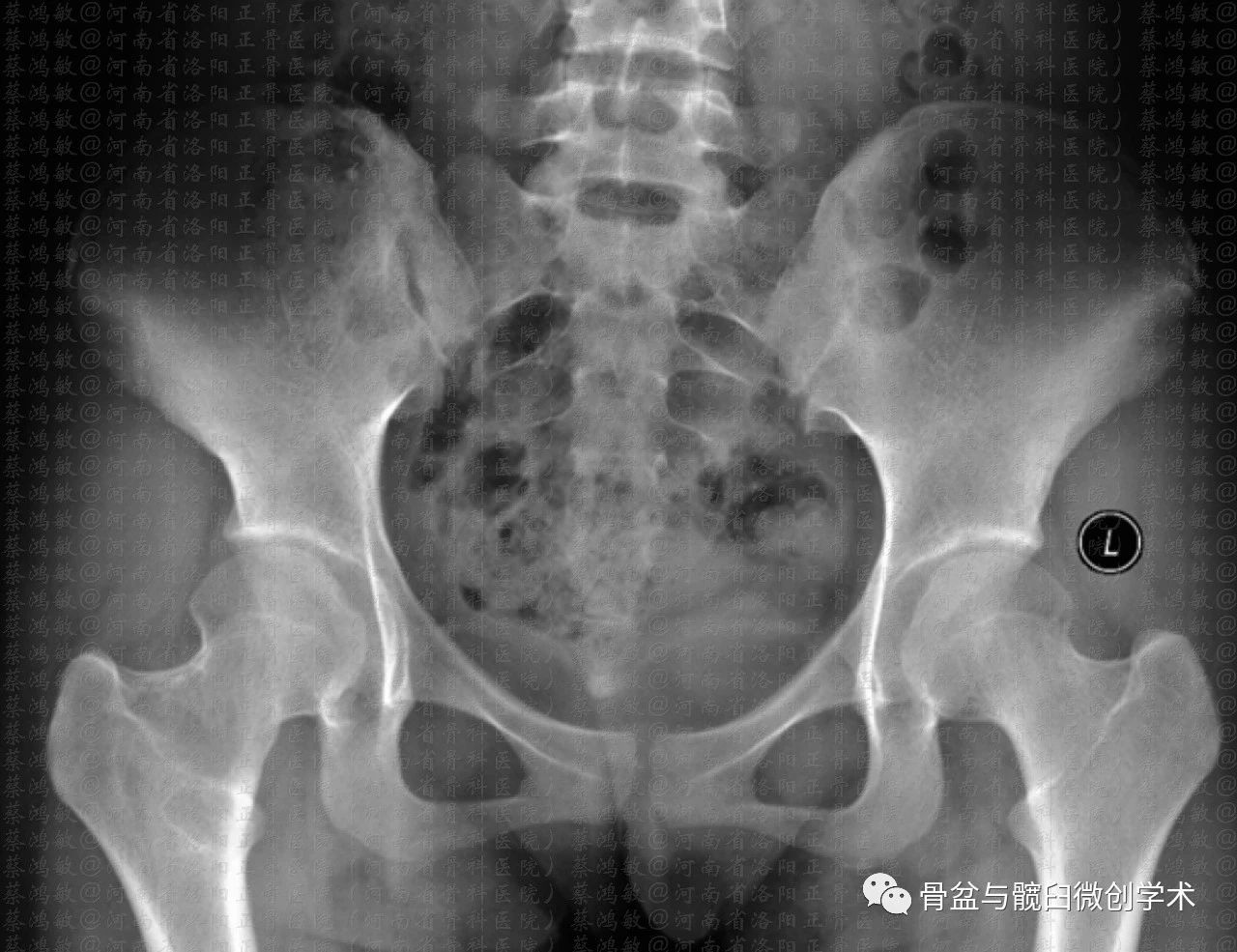 2例术中在以髂嵴为支点翘起骨块过程中出现髂嵴裂纹骨折,因其无移位而