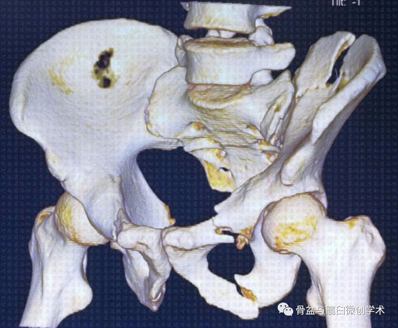 经髂骨骶骨的骶髂关节骨折脱位的微创治疗骶髂螺钉lcii螺钉耻骨上支